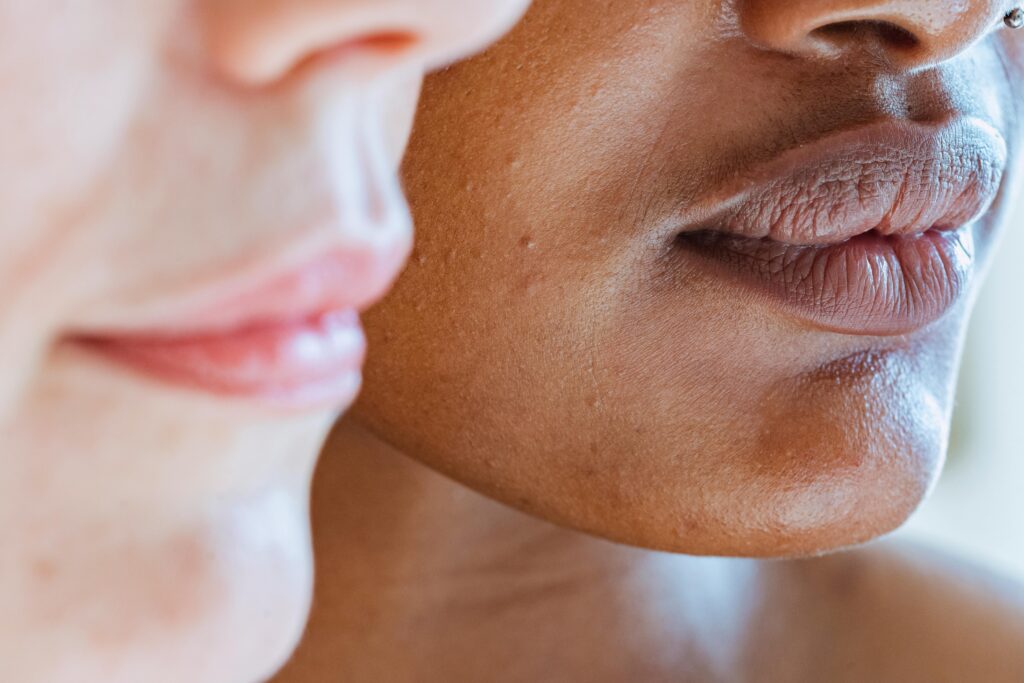 Close-up of two faces showing lip pigmentation before and after treatment for lip pigmentation removal.